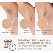 Image : Epilation semi-definitive Philips LUMEA IPL 9000 BRI958/00